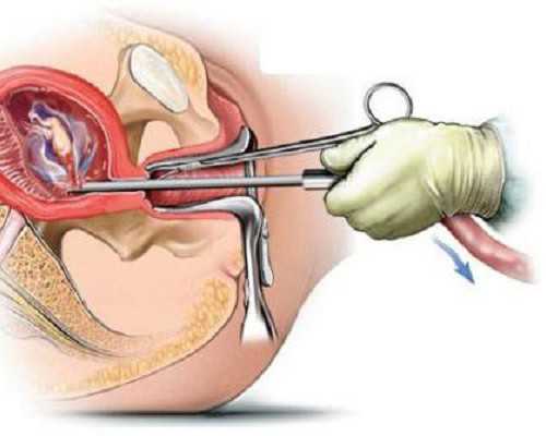 怀孕后塞雪诺酮有黑色白带是怎么回事